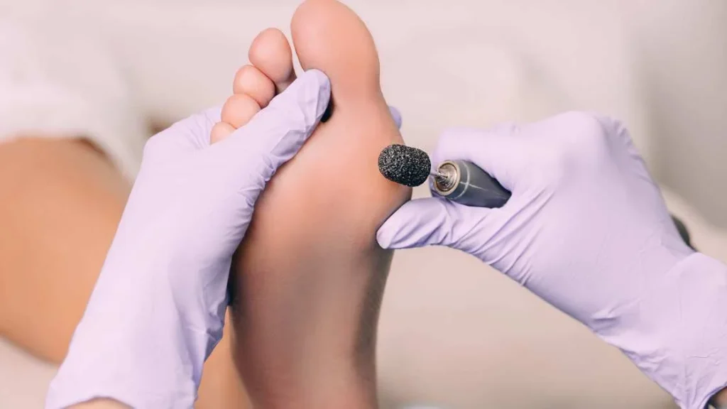 Corn Medicine Foot: The Complete Guide to Treatment, Relief & Prevention Corn Medicine Foot: The Complete Guide to Treatment, Relief & Prevention